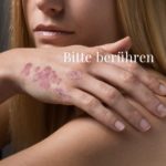 Psoriasis: “Bitte berühren” nicht nur am Tag der Umarmungen