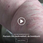Video: Psoriasis – Die Hautkrankheit, die brandmarkt